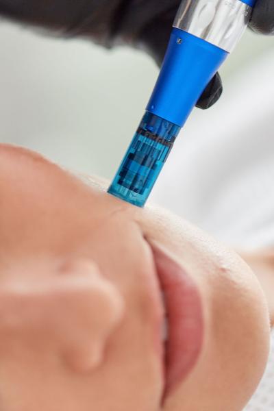 Microneedling