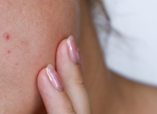 Acné chez les ados : les erreurs à éviter & la routine à adopter