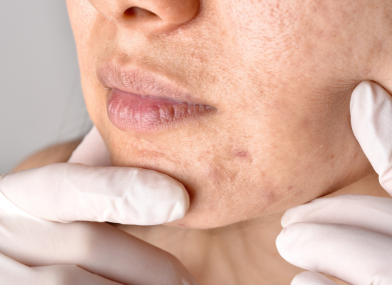 Pores bouchés (clogged pores) : comprendre, prévenir et corriger efficacement